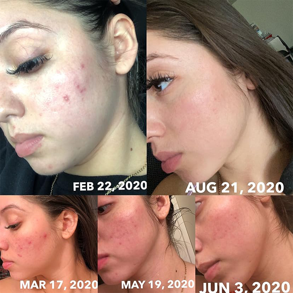ماسک سالیسیلیک اسید اوردینری ضدلک و لایه‌بردار  The Ordinary Salicylic Acid 2% Masque