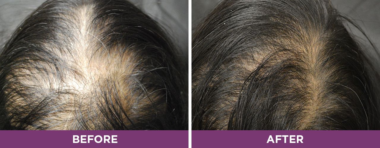 محلول ضد ریزش فیتوسیان