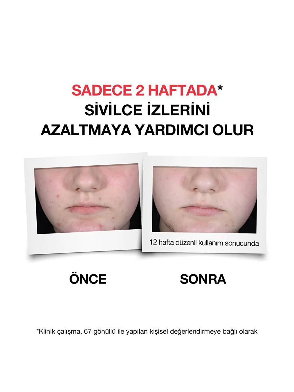سرم ضد جوش پلاس نوتروژینا